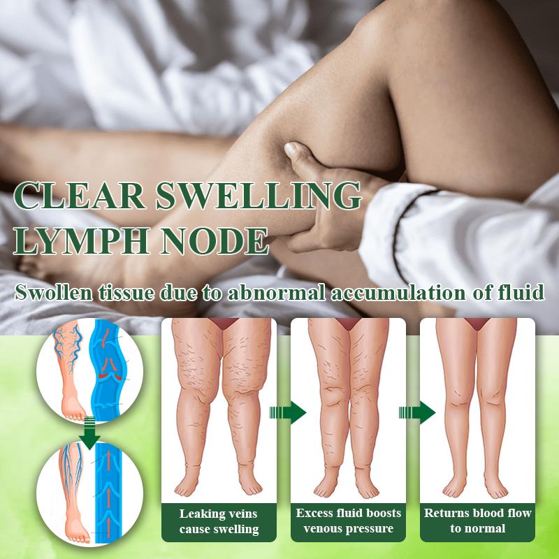 Oveallgo® VeinoRoll Therapy Edema Comfort Cream