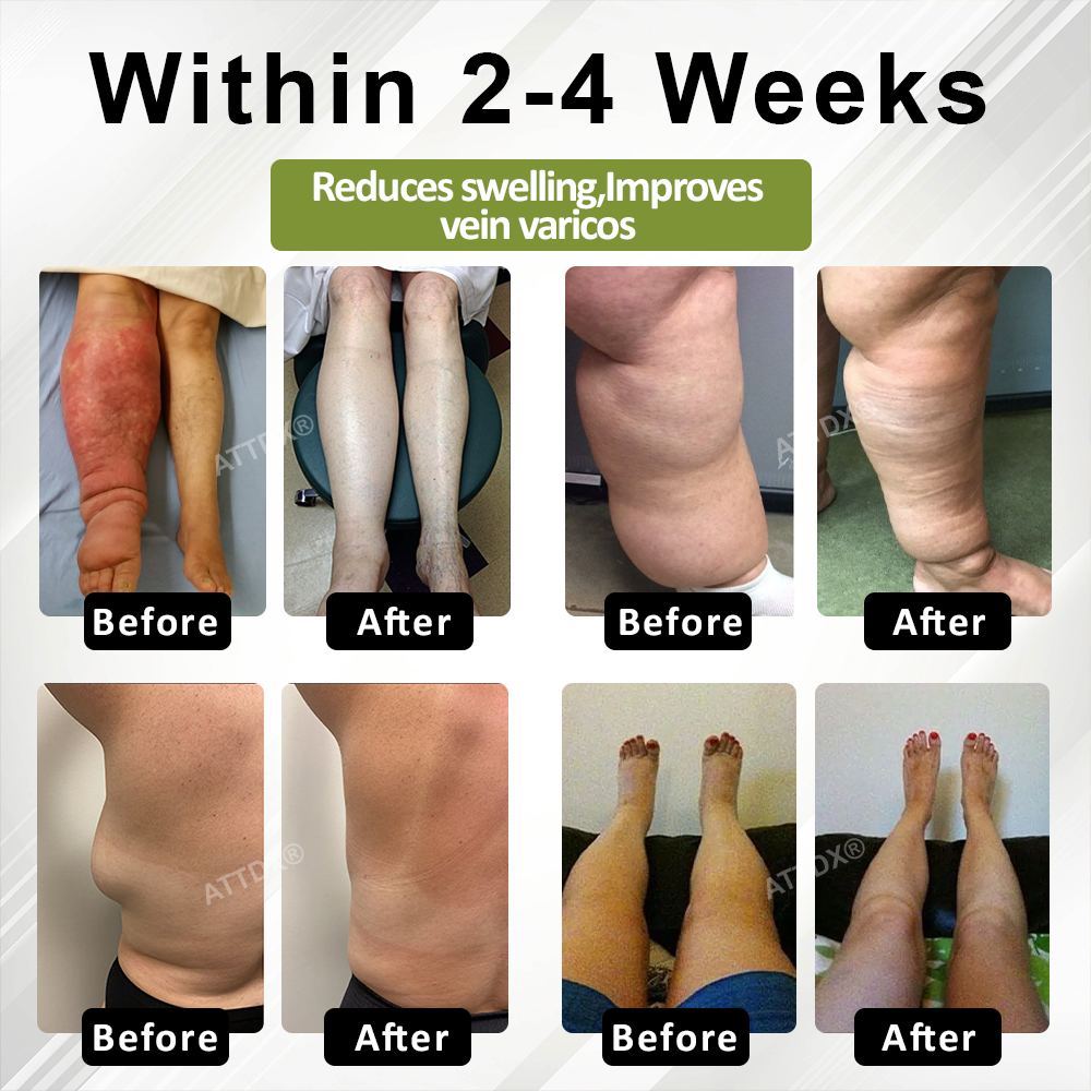 Oveallgo® VeinoRoll Therapy Edema Comfort Cream