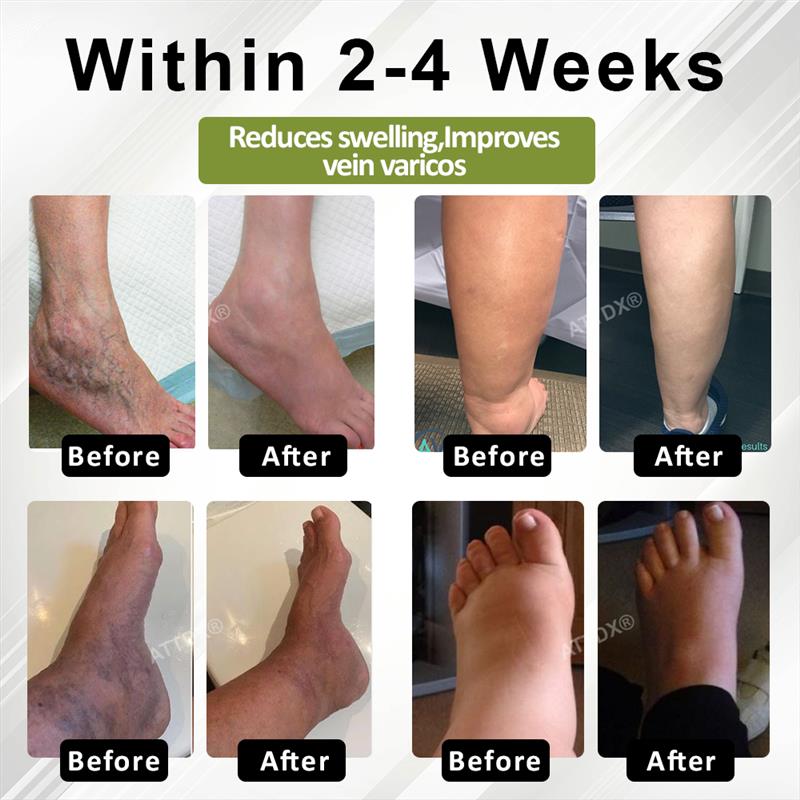 Oveallgo® VeinoRoll Therapy Edema Comfort Cream