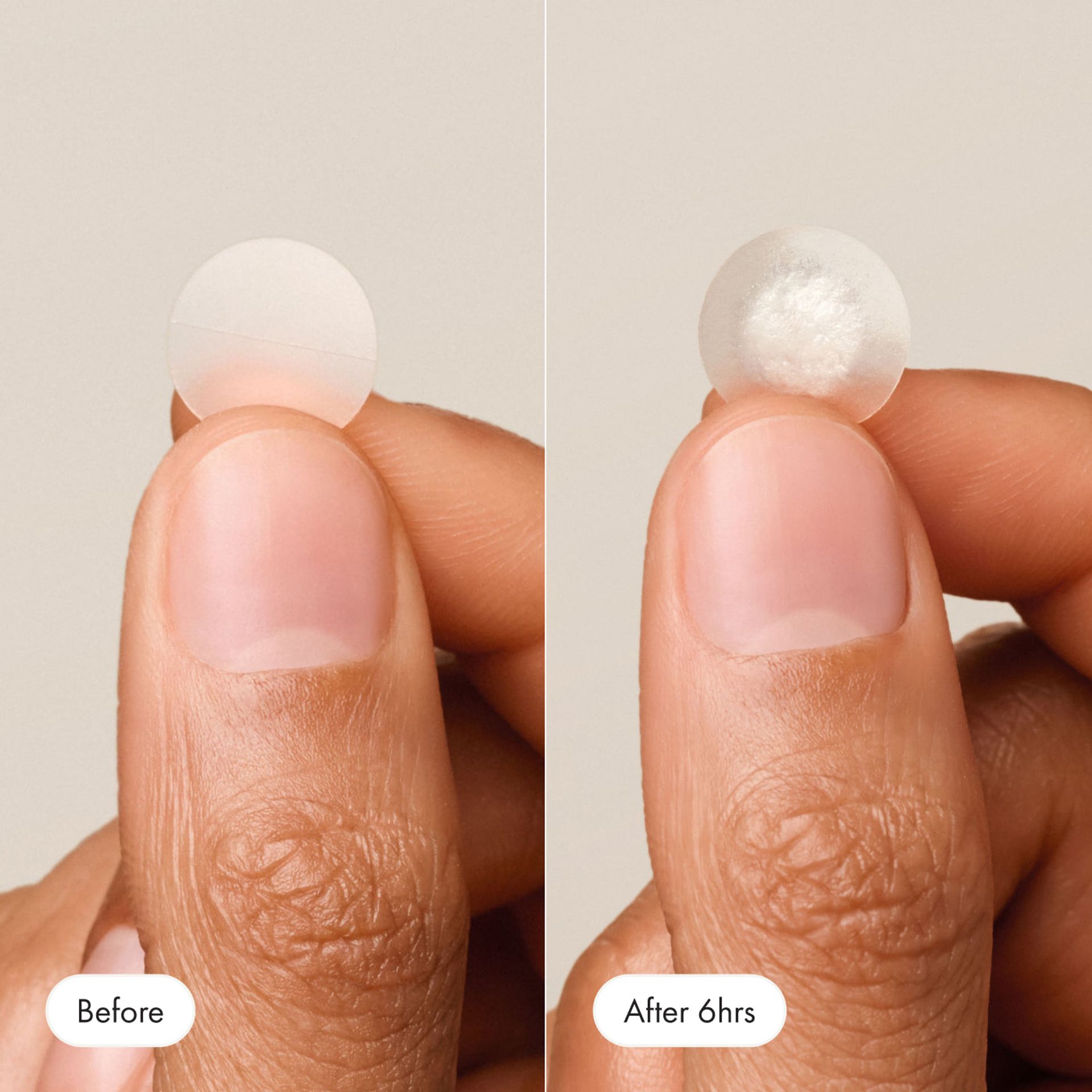 ✨ Mighty Patches™ Original – Invisible Zit Hero ✨