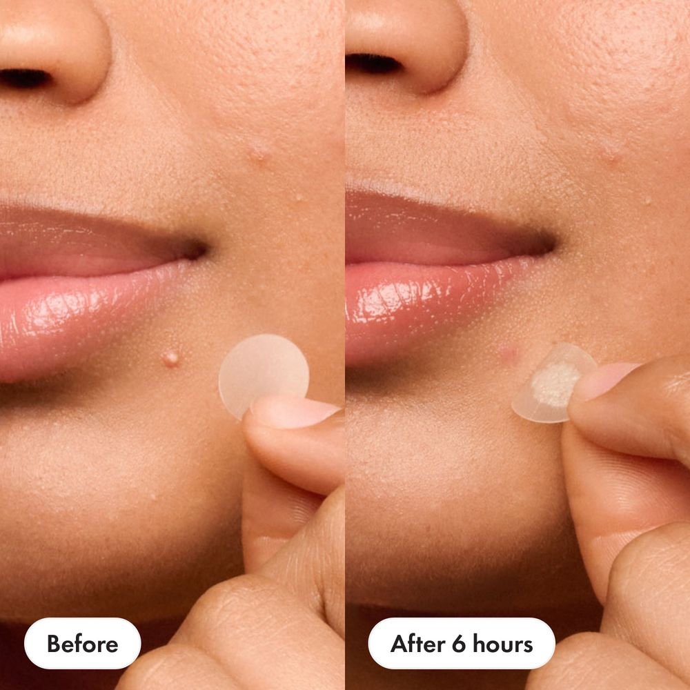 ✨ Mighty Patches™ Original – Invisible Zit Hero ✨